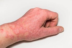 mano con dermatite atopica